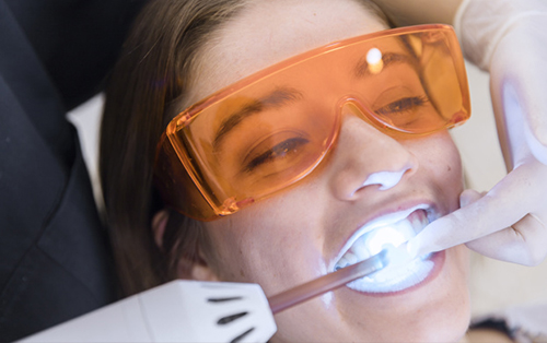 clinica dental acentejo tenerife blanqueamiento dental