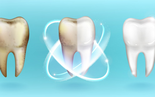 clinica dental acentejo tenerife blanqueamiento dientes