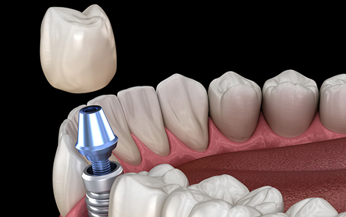 clinica dental acentejo tenerife implante dental carga inmediata