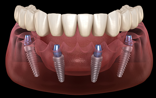 Implantes dentales ALL-ON-4