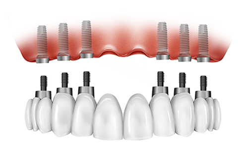 Implantes dentales ALL-ON-6