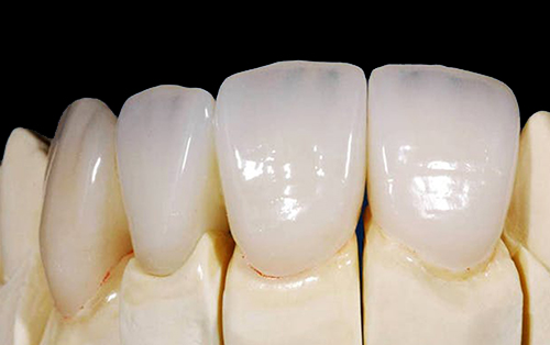 clinica dental acentejo tenerife implantes dentales protesis zirconio