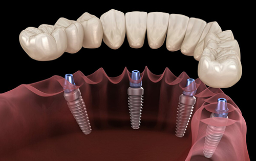 clinica dental acentejo tenerife implantes dentales y protesis