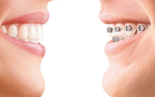 clinica dental acentejo tenerife ortodoncia invisible vs brackets