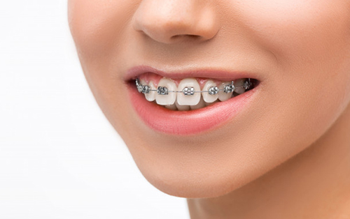 clinica dental acentejo tenerife ortodoncia