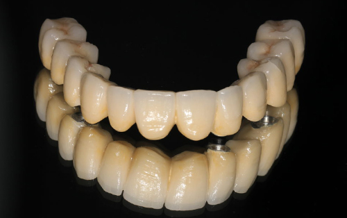 clinica dental acentejo tenerife protesis carga inmediata